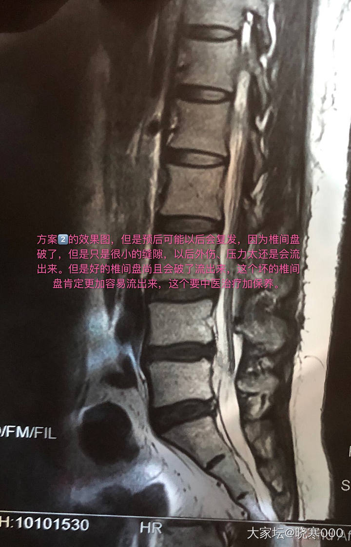 椎间盘突出明天手术了 选择了方案二_健康