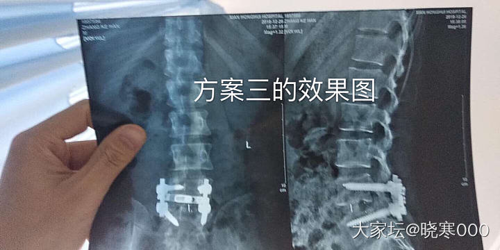 椎间盘突出明天手术了 选择了方案二_健康