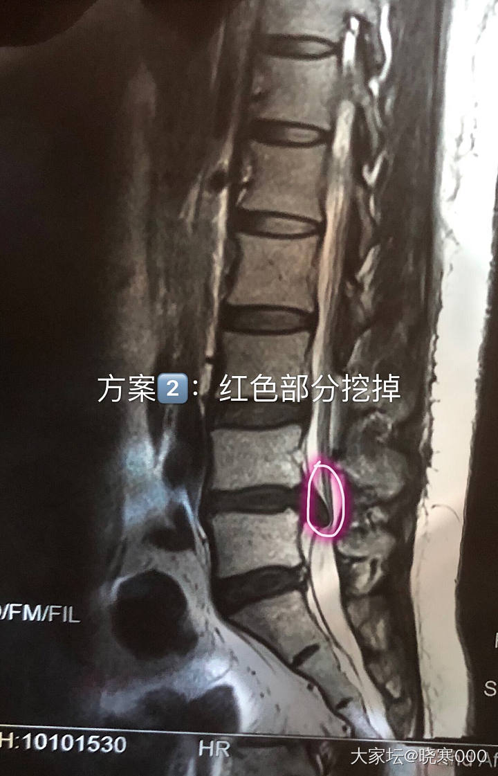 椎间盘突出明天手术了 选择了方案二_健康