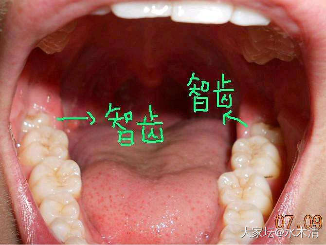 我也要问问智齿_健康