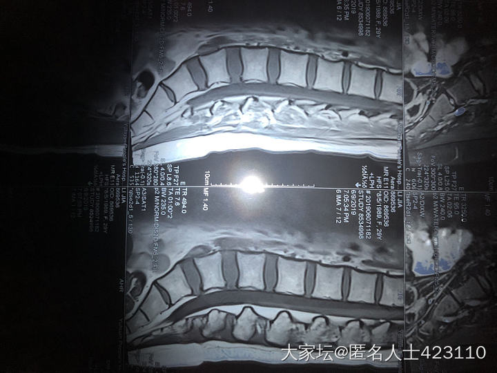 椎间盘膨出了 腰疼啊……_健康