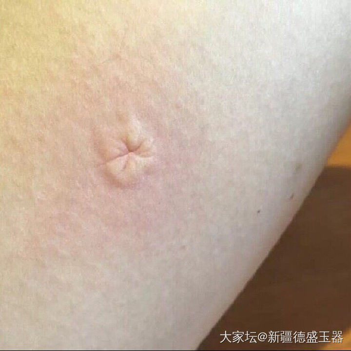 被蚊子咬了以后_闲聊