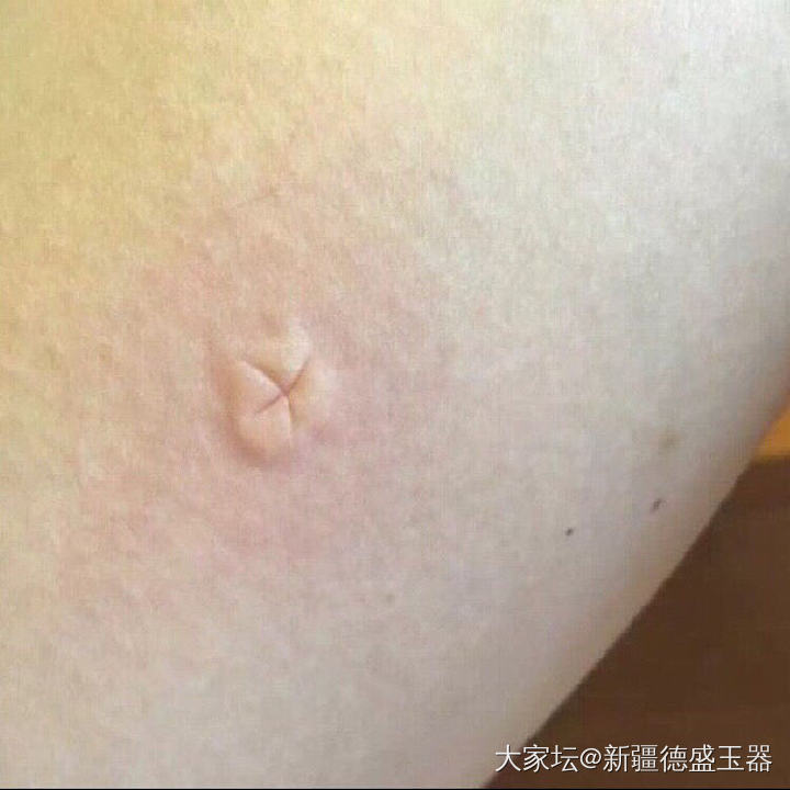 被蚊子咬了以后_闲聊