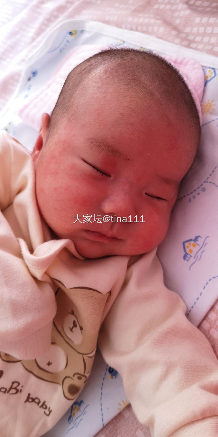 小宝宝脸上疹子反反复复怎么办_婴儿