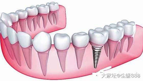 请教有种牙经验的坛友_健康