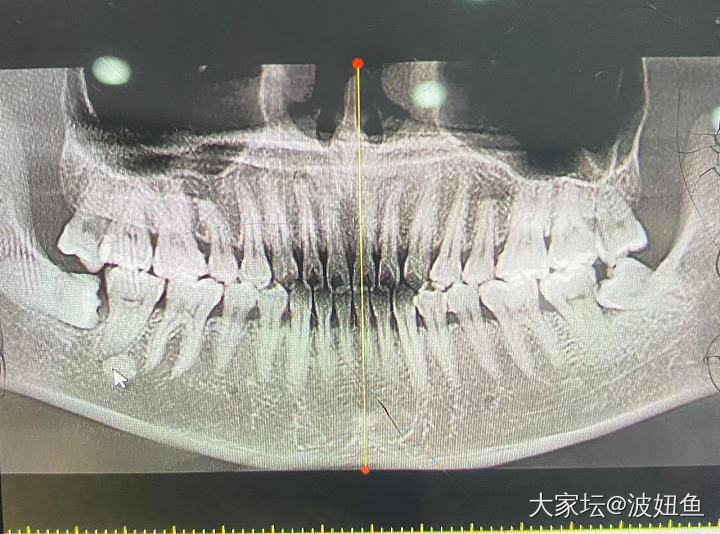 拔牙前最后一顿大餐，魔咒般的牙CT据说谁拍谁拔