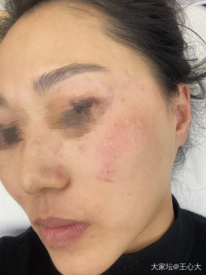 今天是年前第三次做皮秒，生完孩子脸上斑点严重了好多，敷衍麻药今天不知道怎么回事有...