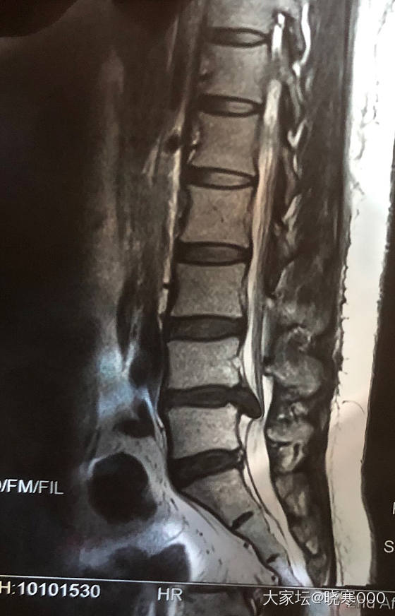 椎间盘突出明天手术了 选择了方案二_健康