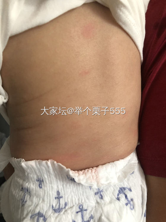 宝宝湿疹怎么办_健康婴儿