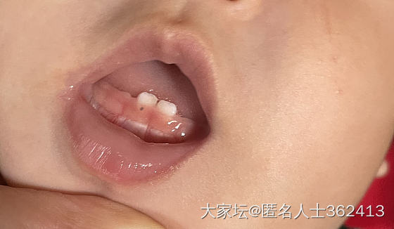 八个月的宝宝牙龈上有黑点_贴图育教亲子