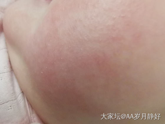 五个月婴儿脸上起了好多湿疹_婴儿健康