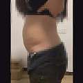 70公斤的浙江姑娘认为抽脂减肥无效要求退款。