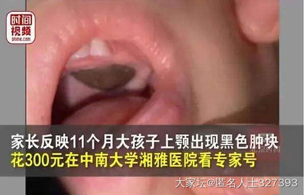 教授将莲子壳初诊为肿瘤，有没有错？_新闻