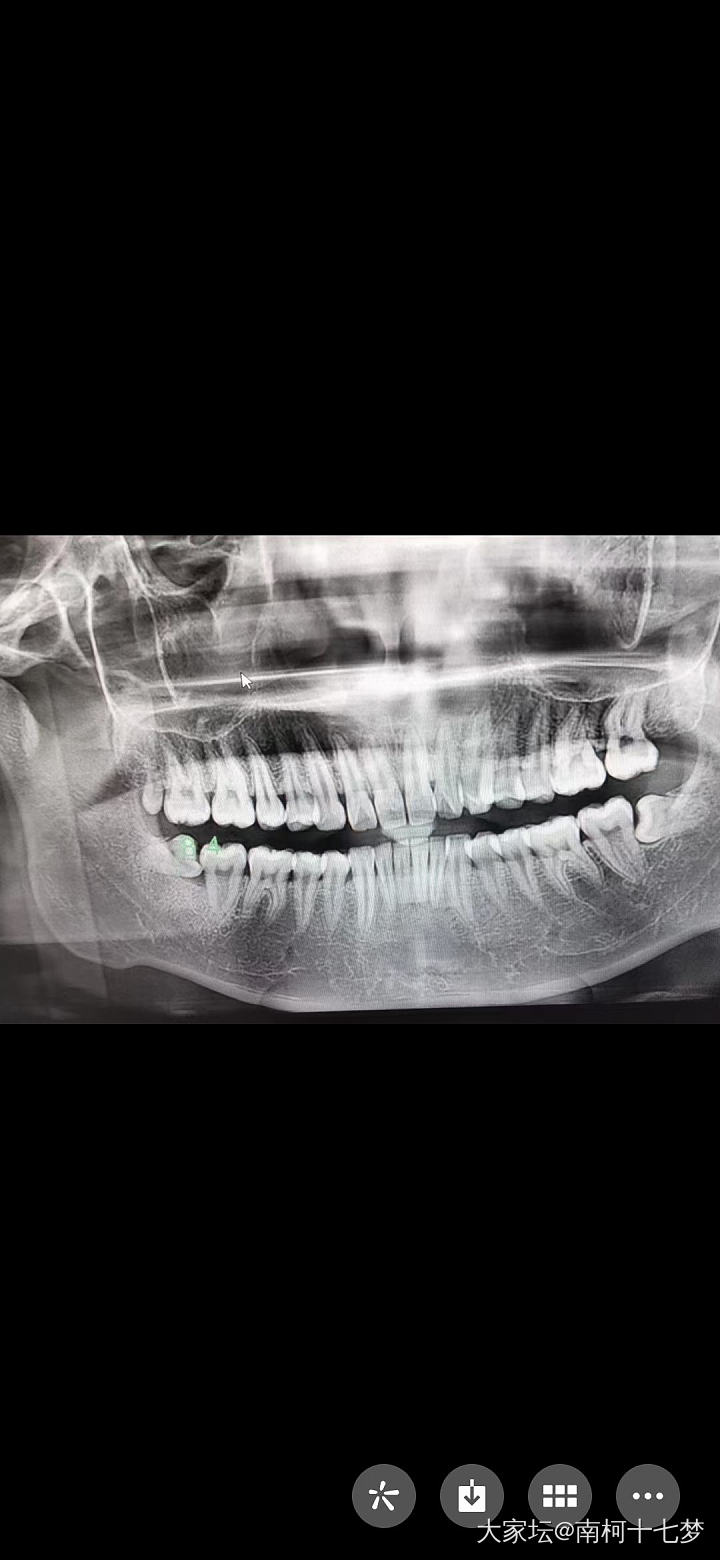有没有拔智齿半个月牙龈还在肿痛的_健康闲聊大家谈