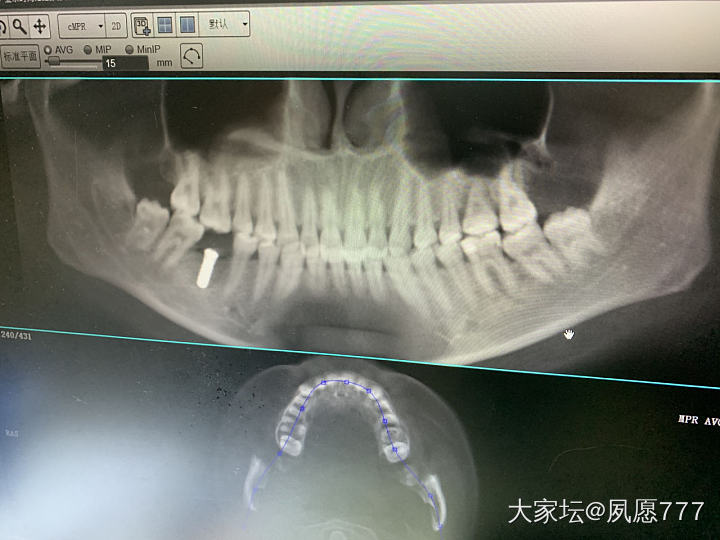 自体牙移植手术第一天_健康