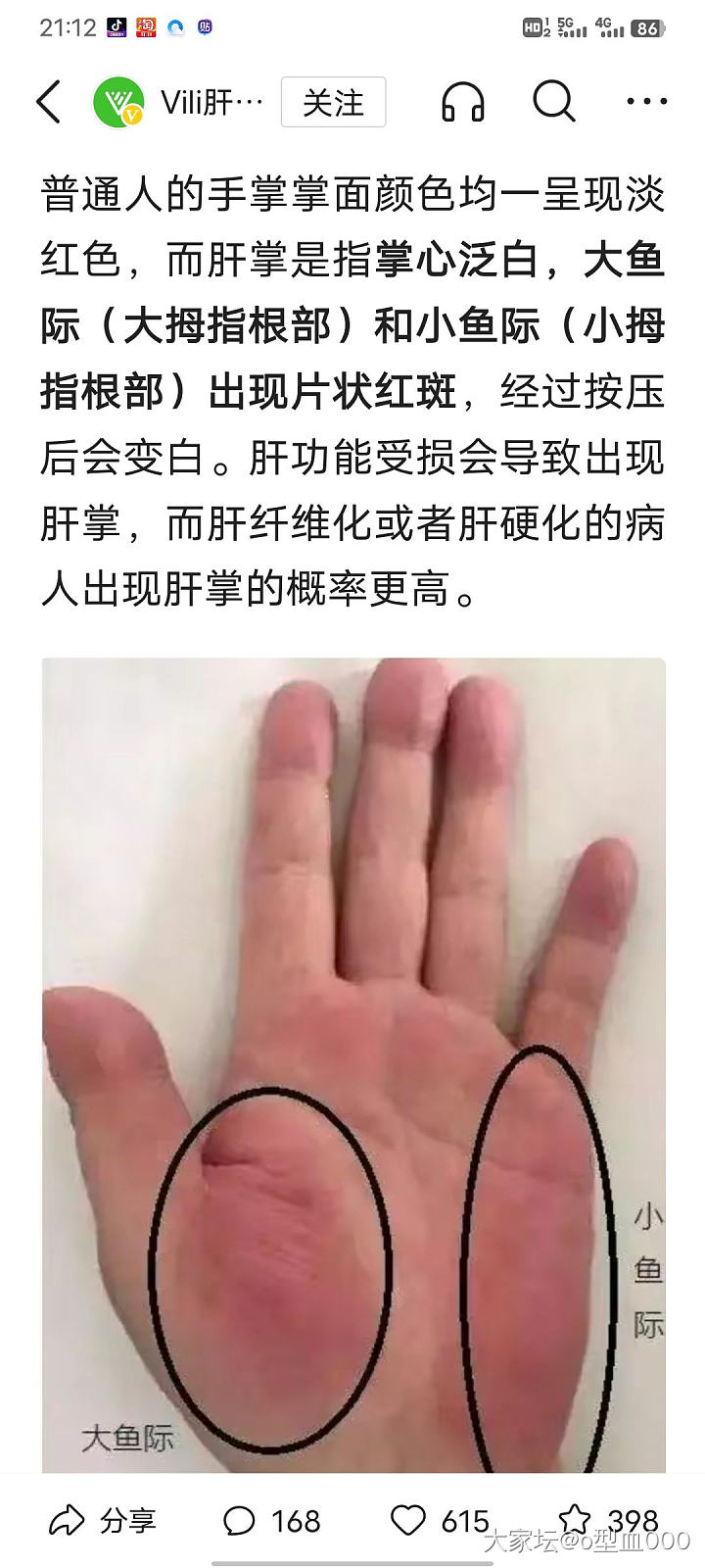 健康问题，我这是肝掌吗_健康