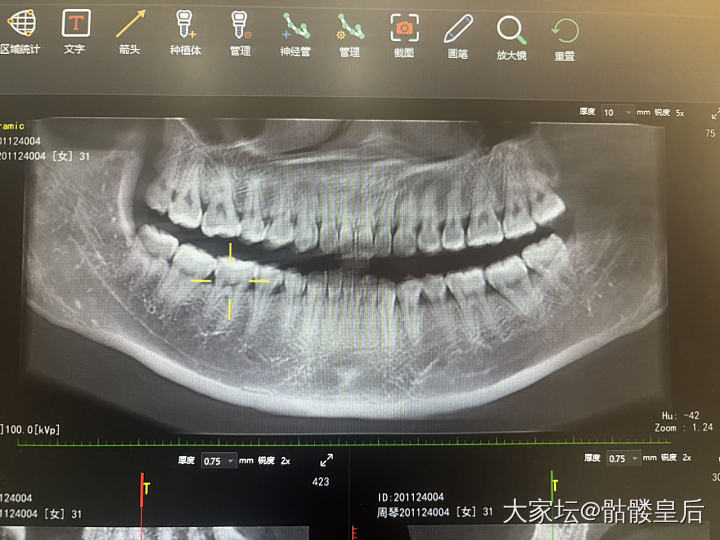 近年关了补牙有影响吗？_健康