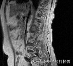 寻求帮助坛里的骨科医生给点专业意见🙏_健康