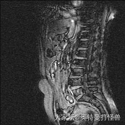 寻求帮助坛里的骨科医生给点专业意见🙏_健康