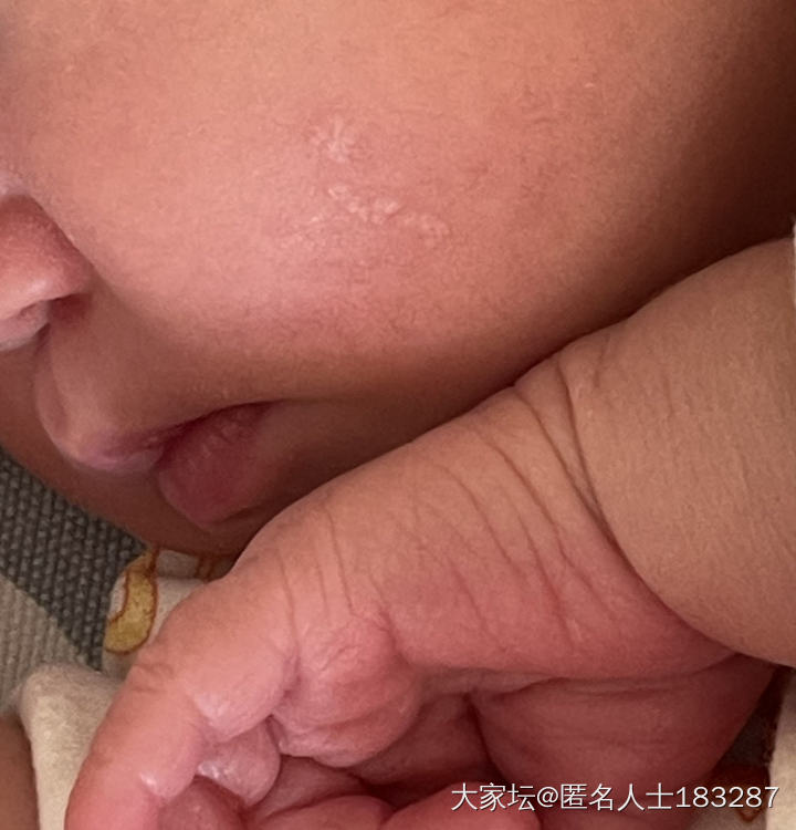 宝宝脸上是皮脂腺痣吗？_健康