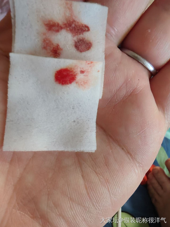 昨天看坛友发的帖子立马试了试，老祖宗的智慧真的是不服不行啊。
起因是我本来是肝火..._健康