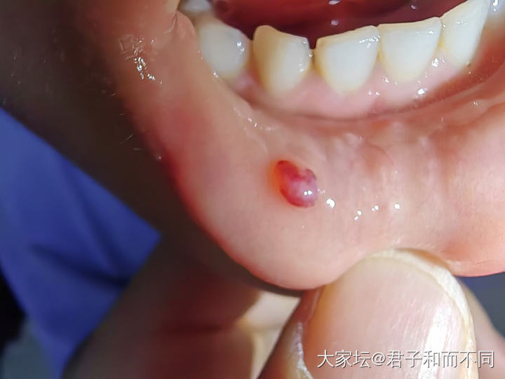 😆😆小妞又长个囊肿_健康育教亲子
