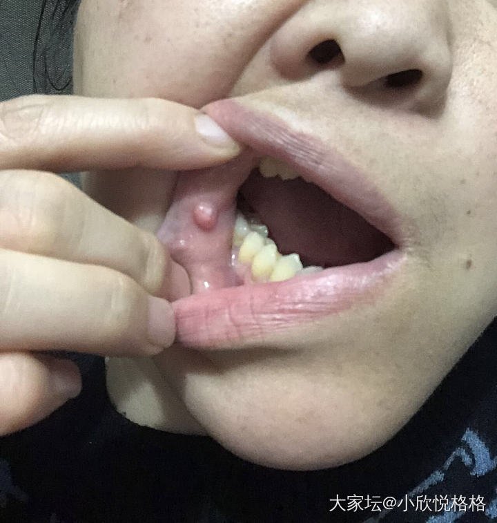 😆😆小妞又长个囊肿_健康育教亲子