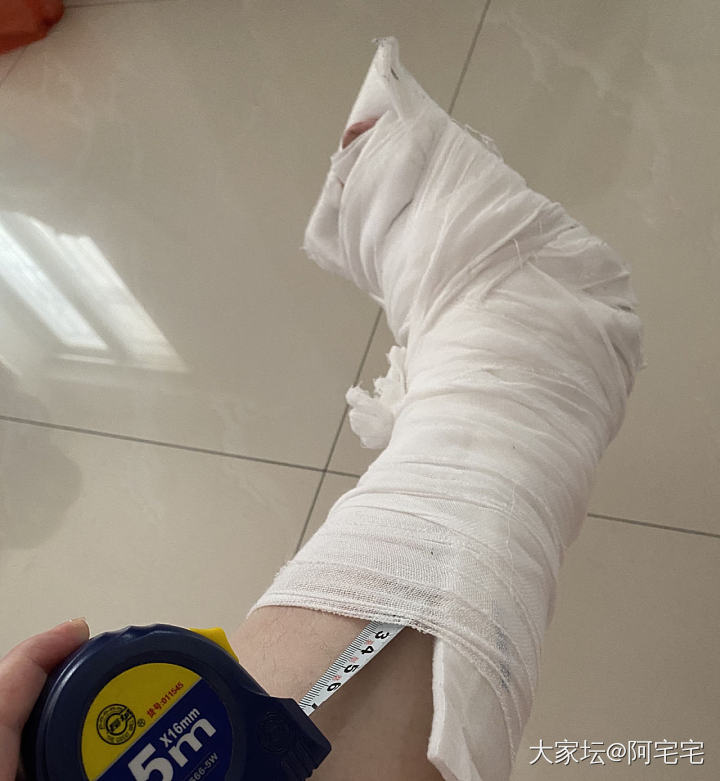 打了石膏以后里面皮肤痒怎么办？_健康
