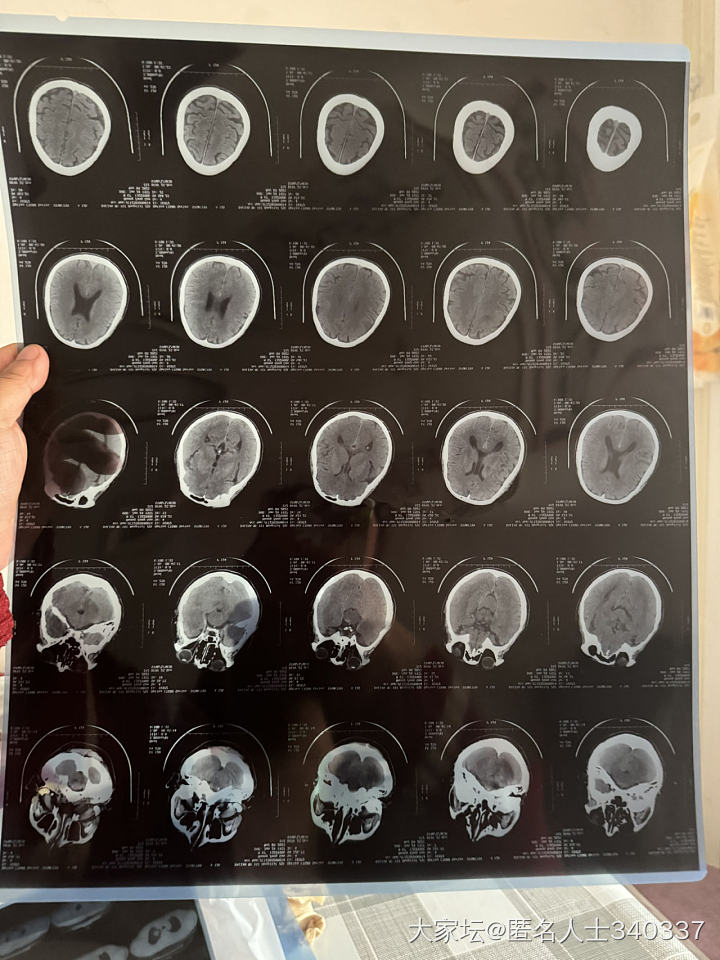 坛子里有医生吗？或者会看报告的，麻烦能不能帮忙看看病例，谢谢大家_健康