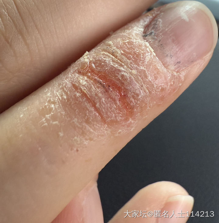 孩子的手这个是湿疹吗？看了两个医生都说是湿疹，但是擦了地奈德没有好，几个月了，哎..._健康