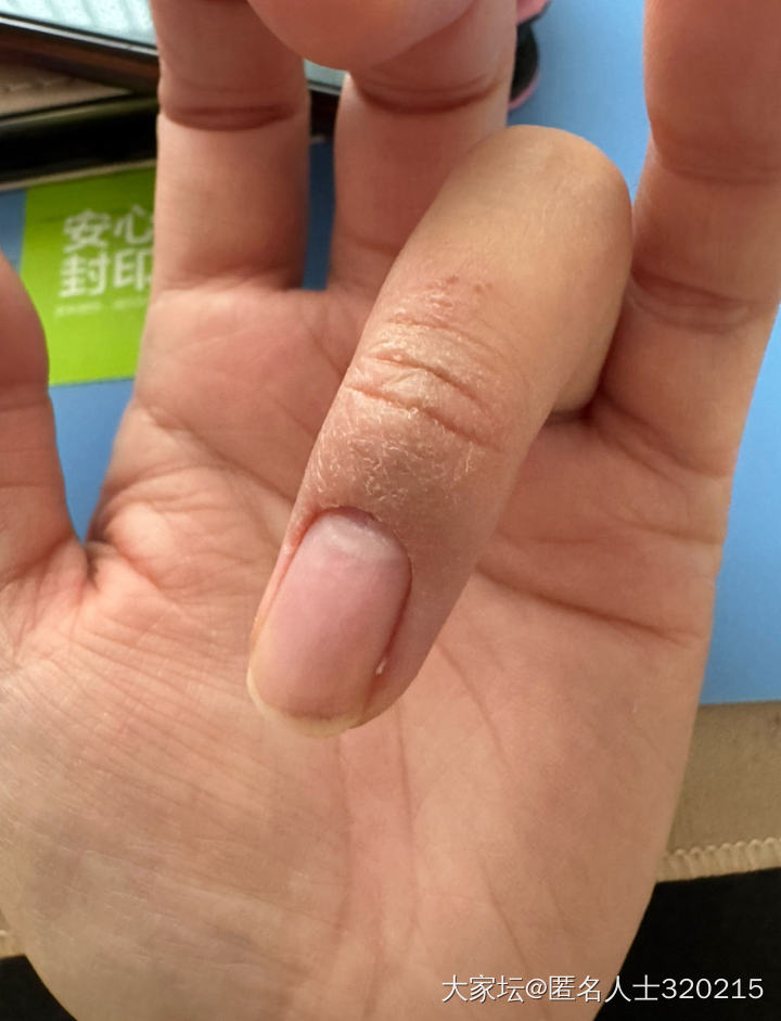 孩子的手这个是湿疹吗？看了两个医生都说是湿疹，但是擦了地奈德没有好，几个月了，哎..._健康
