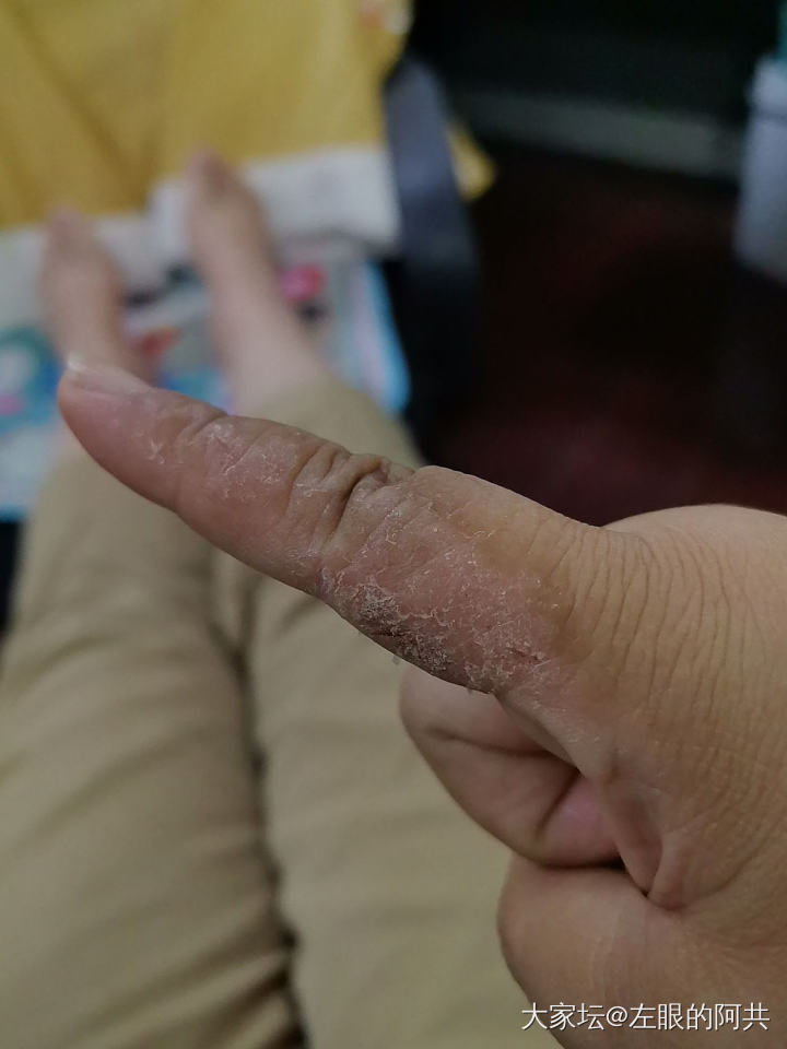 孩子的手这个是湿疹吗？看了两个医生都说是湿疹，但是擦了地奈德没有好，几个月了，哎..._健康