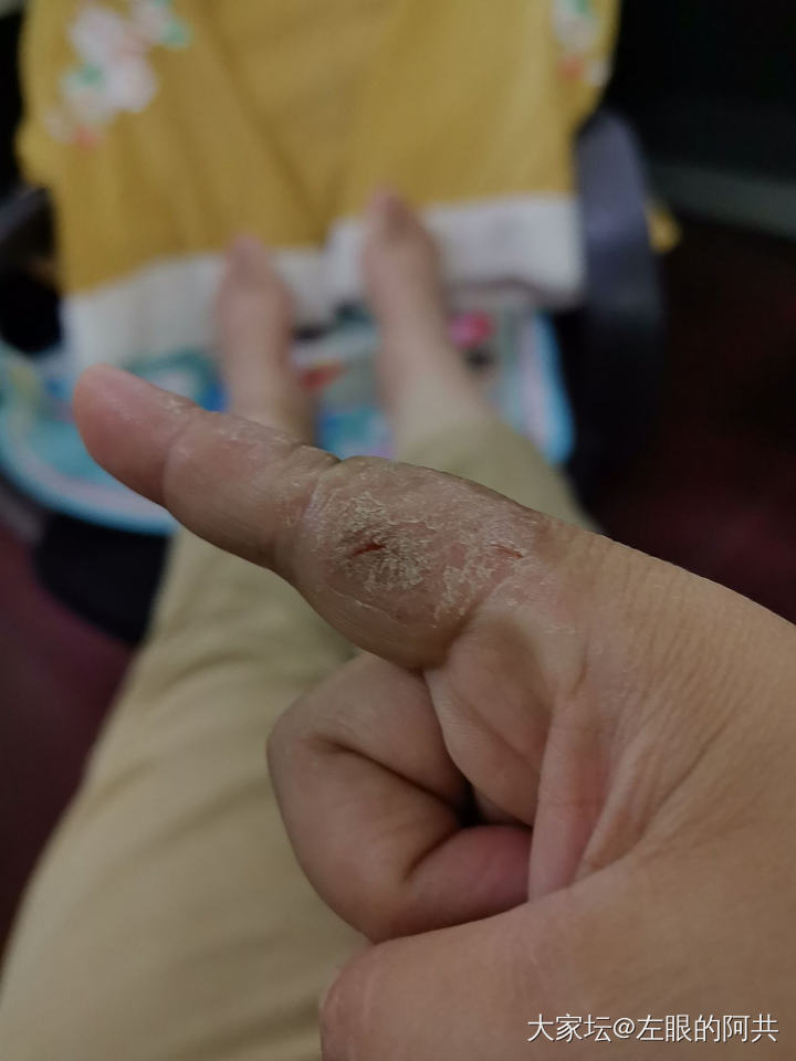 孩子的手这个是湿疹吗？看了两个医生都说是湿疹，但是擦了地奈德没有好，几个月了，哎..._健康
