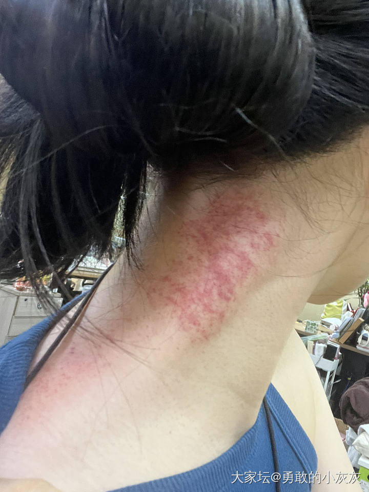 脖子疼，对自己下手了_健康