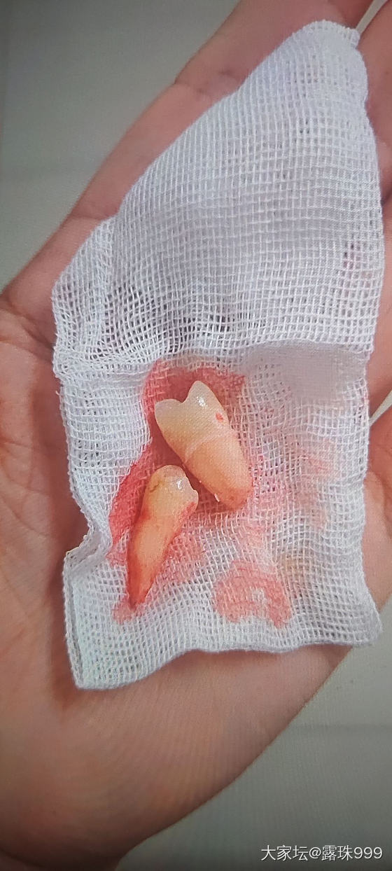 拔智齿十小时后汇报_健康