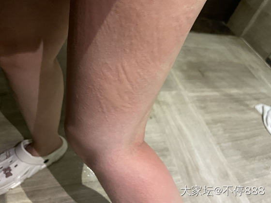 荨麻疹发作_首饰