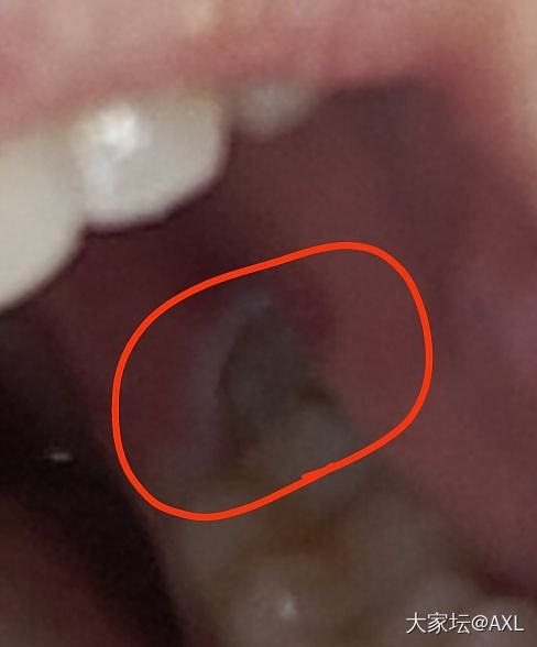 亲们，有拔过智齿的吗?_健康