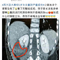 两岁的娃被狗撕咬，肾脏受伤